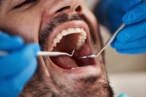 Best Emergency Treatment for Dental Infections or Abscesses in Roslyn, NY